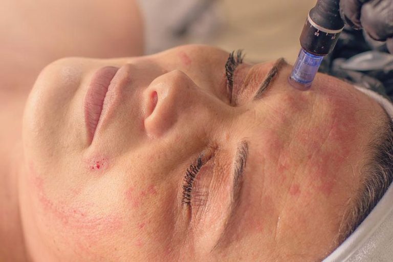 How Does Microneedling Work and Why Does It Allow You to Achieve the Desired Effect?