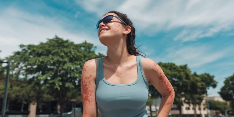 What Is The Rarest Allergy?